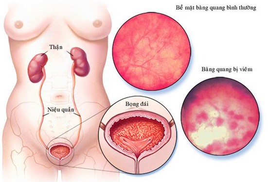 Bệnh viêm bàng quang là gì, có nguy hiểm không?