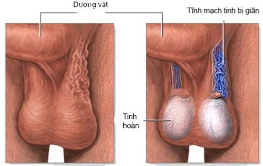 Suy tinh hoàn gây ảnh hưởng như thế nào?