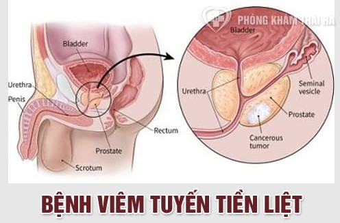 Viêm tuyến tiền liệt ở nam giới là bệnh gì và cách chữa trị?